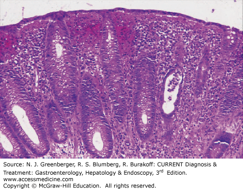 AccessMedicine's Image of the Week: Rectal Mucosal Biopsy Specimen: Shigellosis
