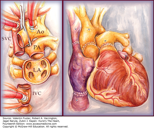 AccessMedicine's Image of the Week: Cardiac Transplantation