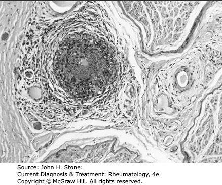 AccessMedicine's Image of the Week: Vasculitic Neuropathy in Microscopic Polyangiitis