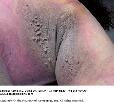 AccessMedicine's Image of the Week: Acanthosis nigricans