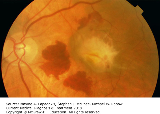 Age-Related Macular Degeneration