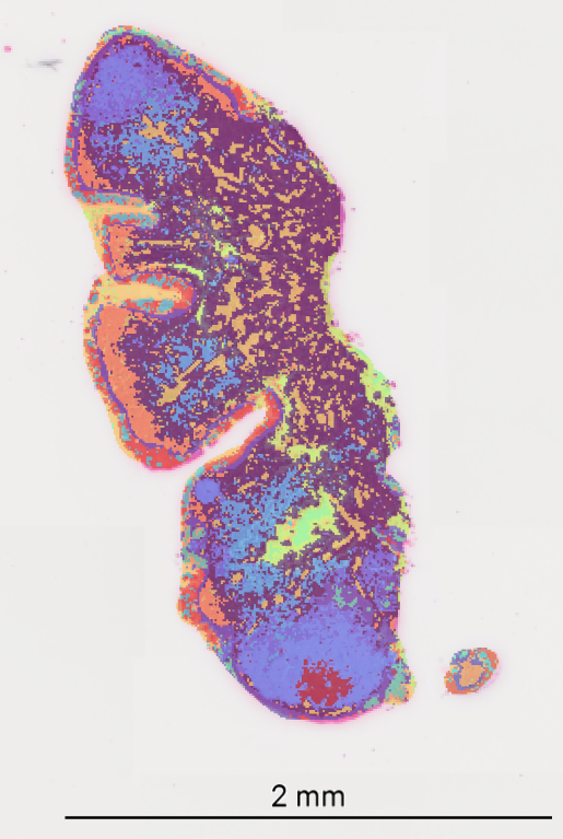 Visium HD Spatial Transcriptomics Reveals Persistent SARS-CoV-2 Signaling in the Epipharynx and the Therapeutic Potential of Epipharyngeal Abrasive Therapy (EAT) in Long COVID