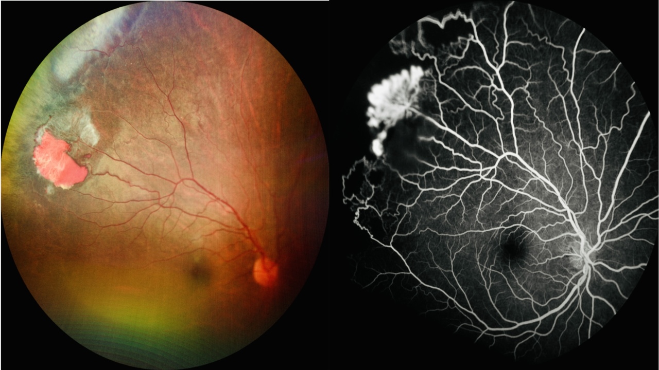 Don’t let sickle cell steal your sight – shedding light on sickle cell retinopathy