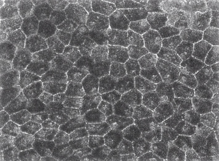 A cell patch for the treatment of blindness