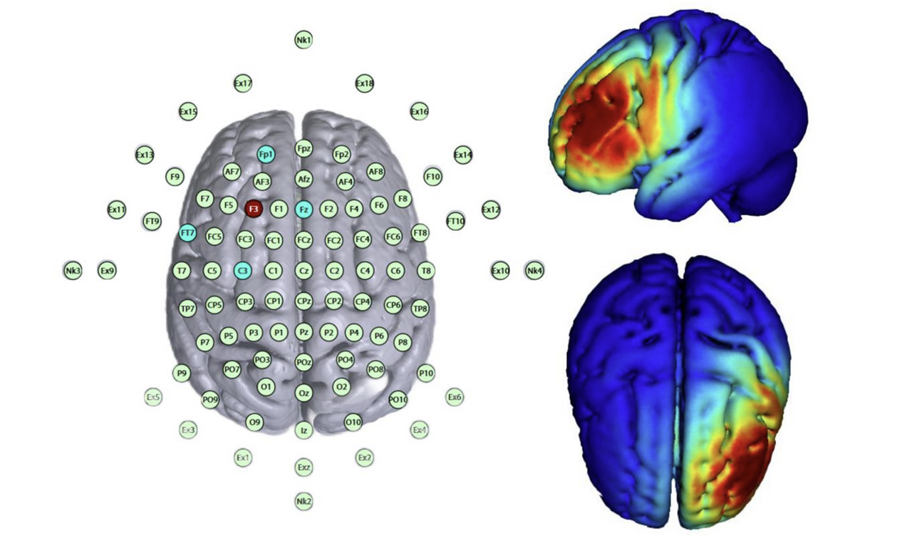 Targeted HD-tDCS over left DLPFC to modify cognitive biases in young adults with social anxiety symptoms